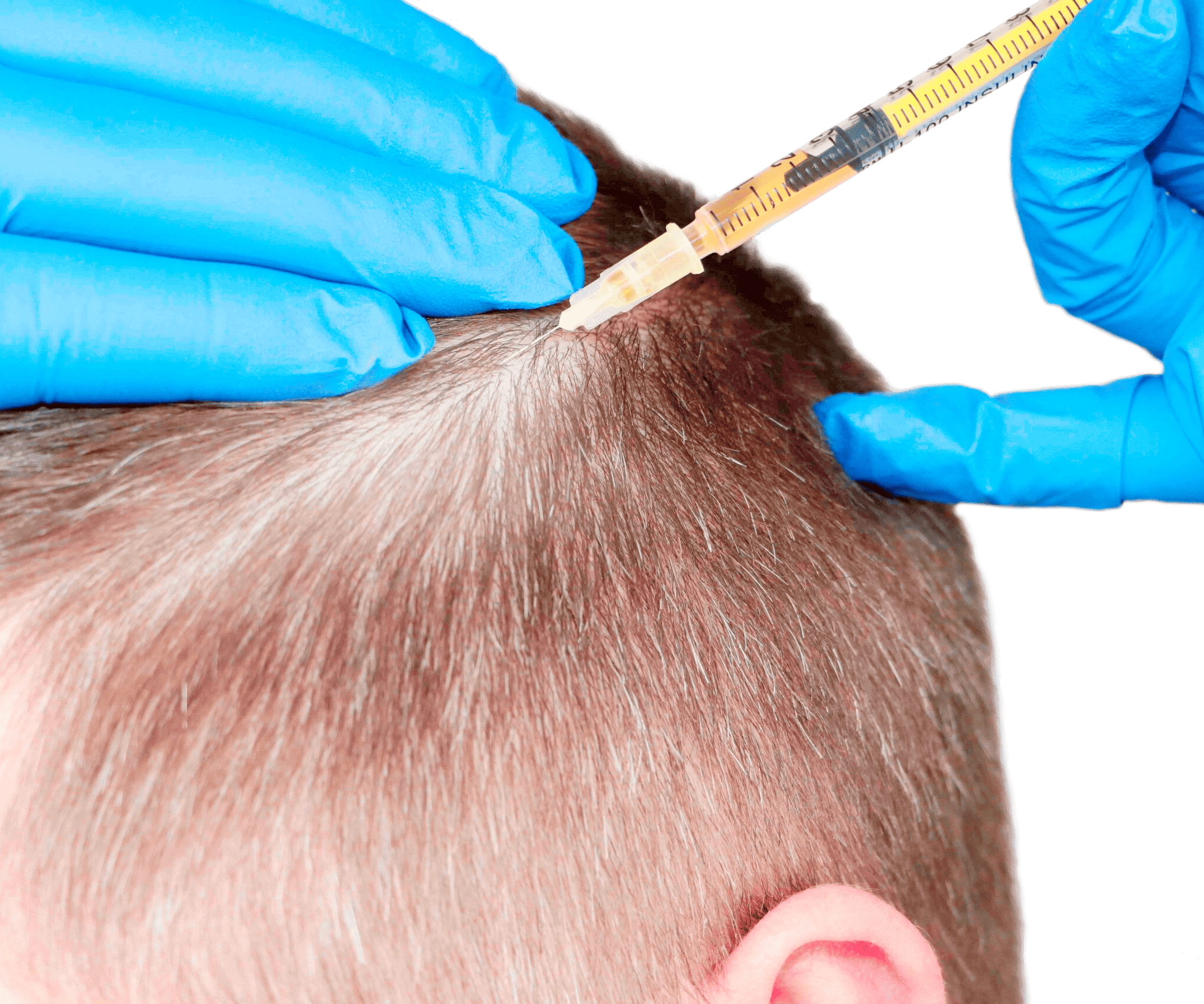 PRP Hair Injections