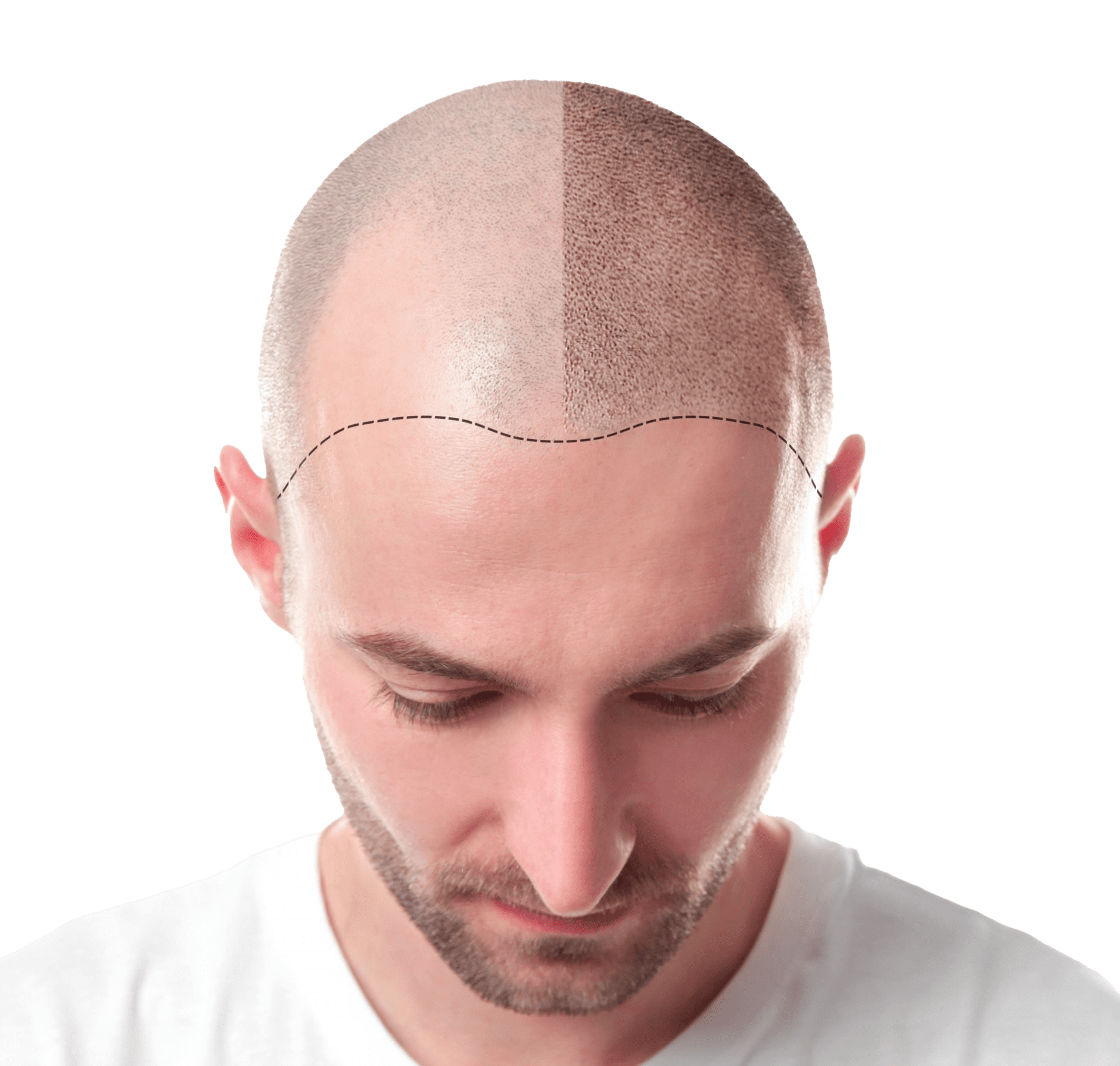 Injections PRP Cheveux Injections PRP Cheveux