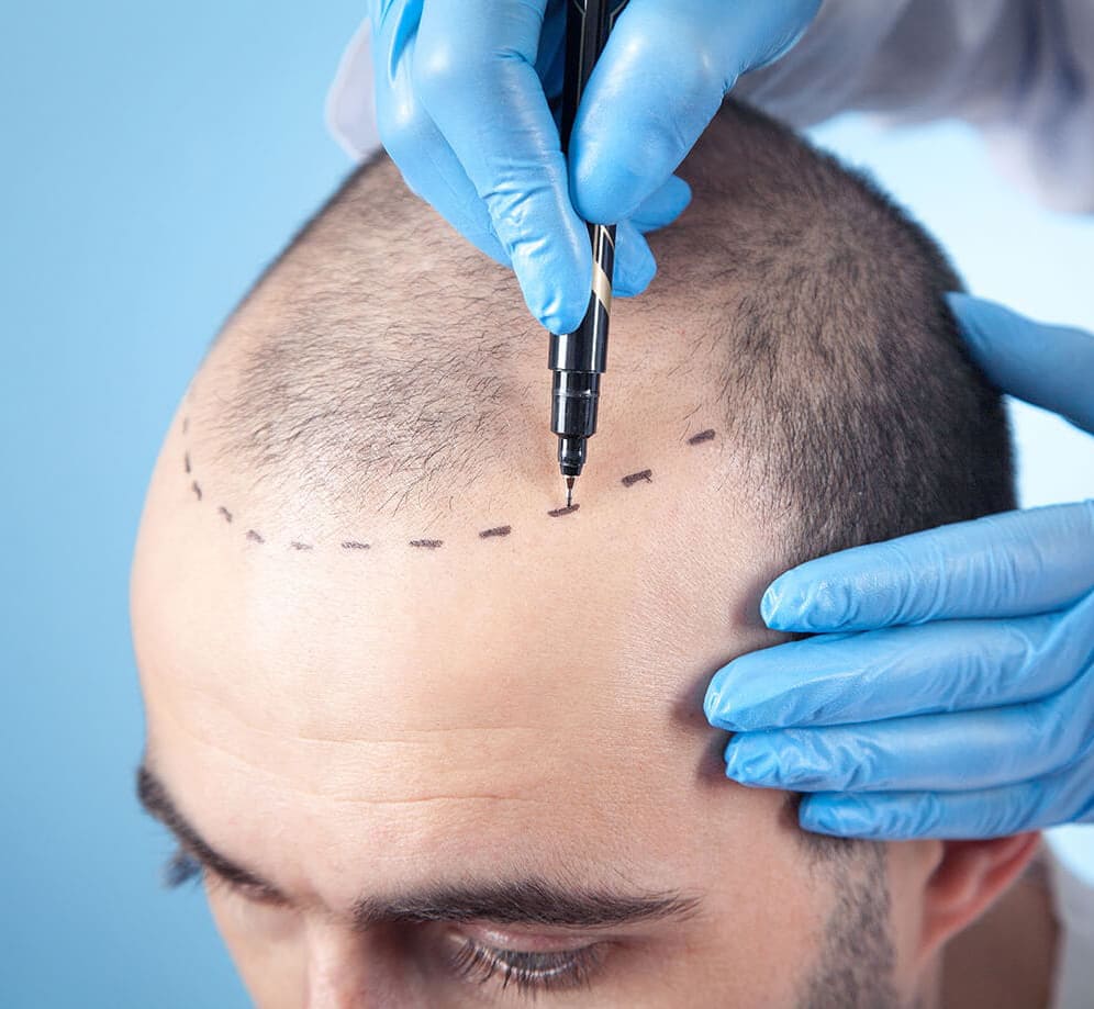 Hair-transplant The secrets of hair transplantation